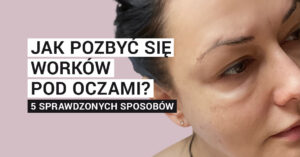 Jak pozbyć się worków pod oczami? 5 sprawdzonych sposobów