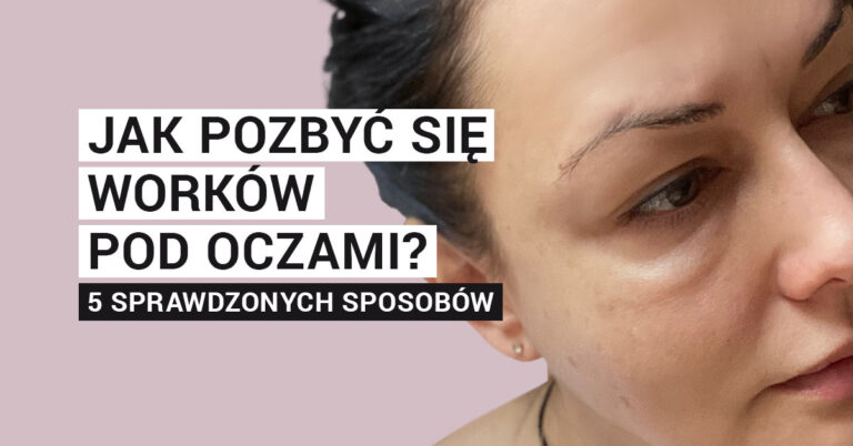 Jak pozbyć się worków pod oczami? 5 sprawdzonych sposobów